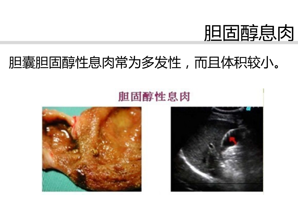胆囊息肉诊治共识_第5页