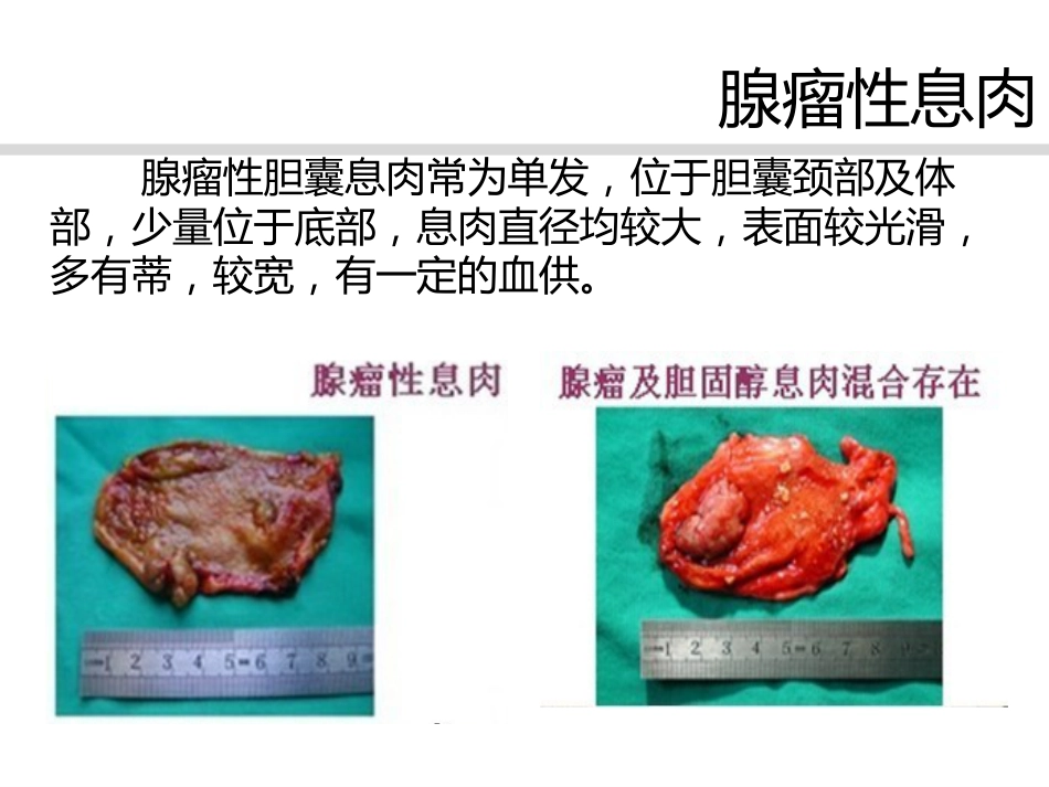 胆囊息肉诊治共识_第6页