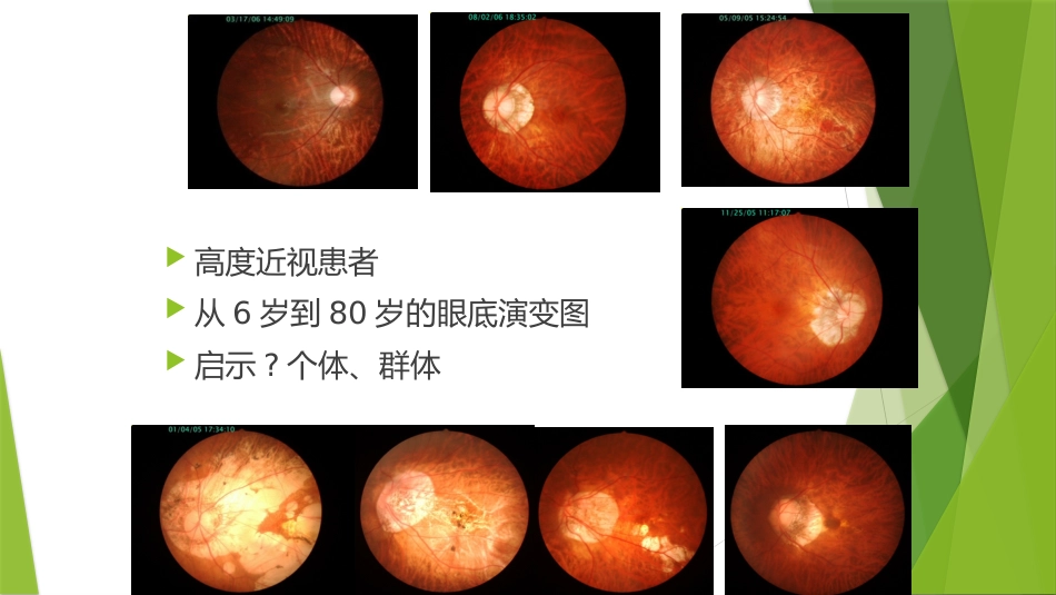 高度近视防控专家共识_第2页