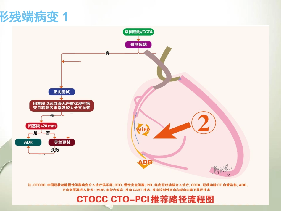 CTO介入治疗处理流程与最新专家共识_第10页
