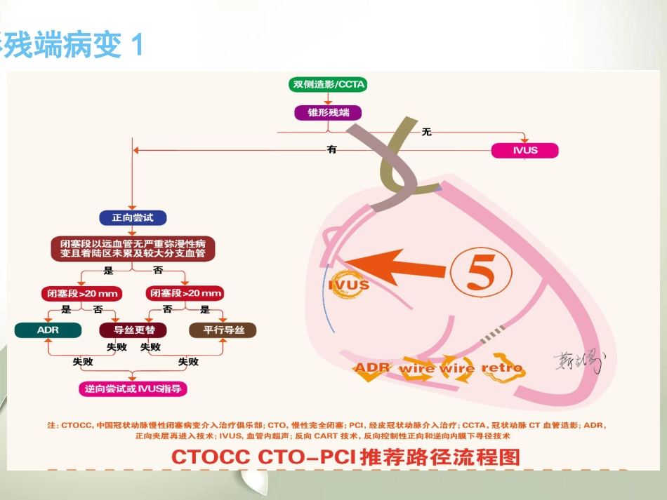 CTO介入治疗处理流程与最新专家共识_第13页