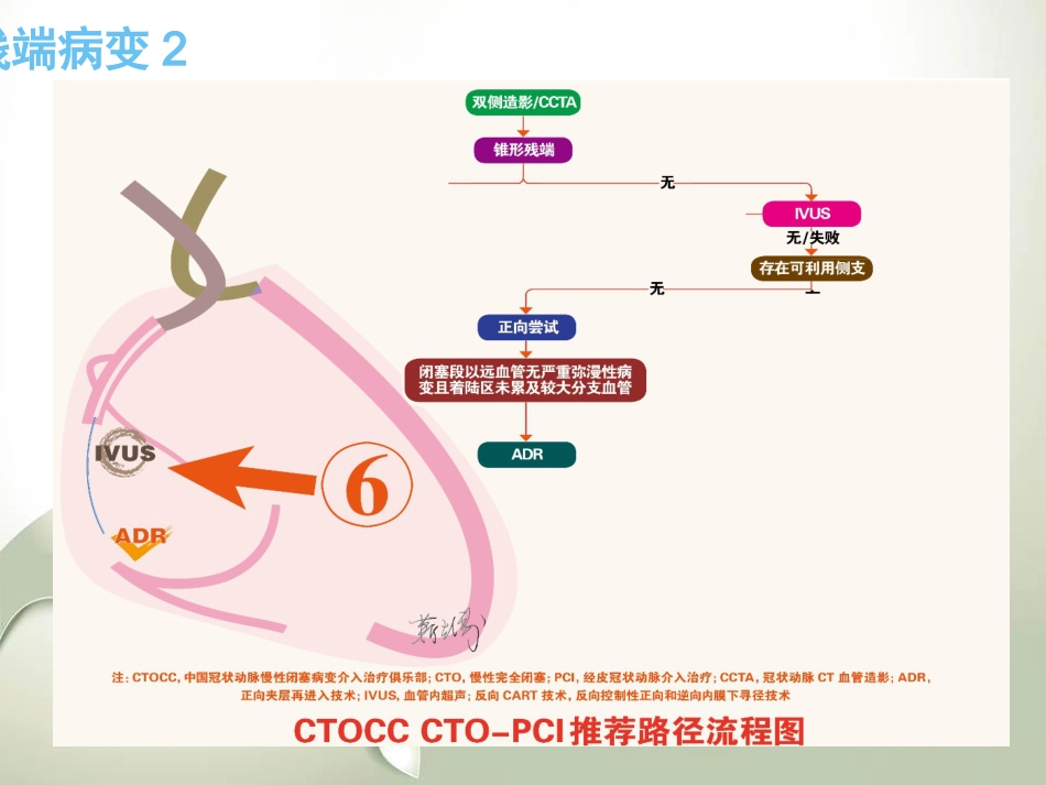 CTO介入治疗处理流程与最新专家共识_第14页