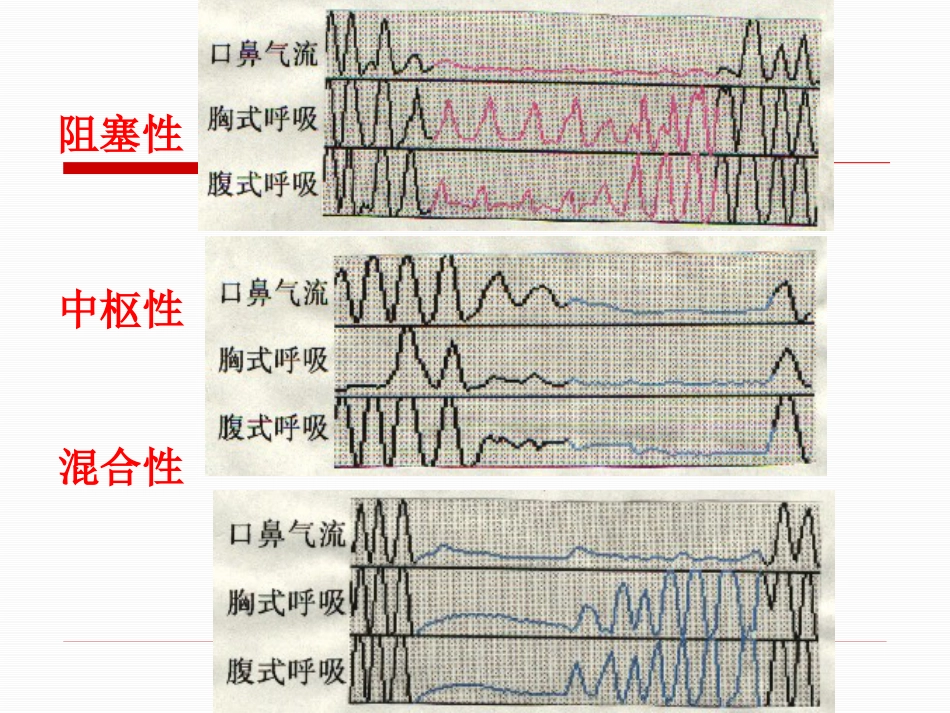 呼吸睡眠暂停综合症诊治专家共识_第7页