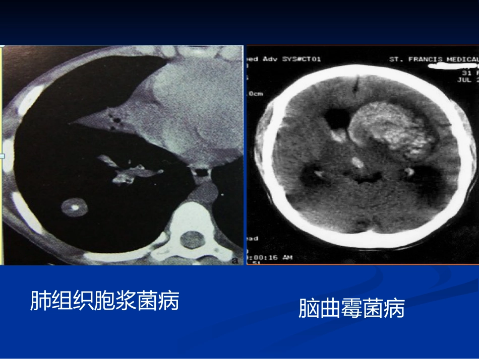 肺部真菌病诊断和治疗专家共识_第9页