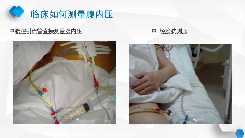 腹内压监测与管理专家共识_第13页
