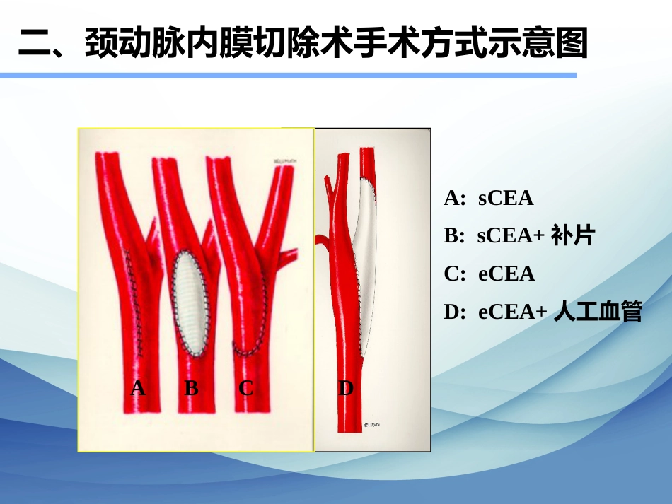 颈动脉狭窄的治疗科普讲座_第14页