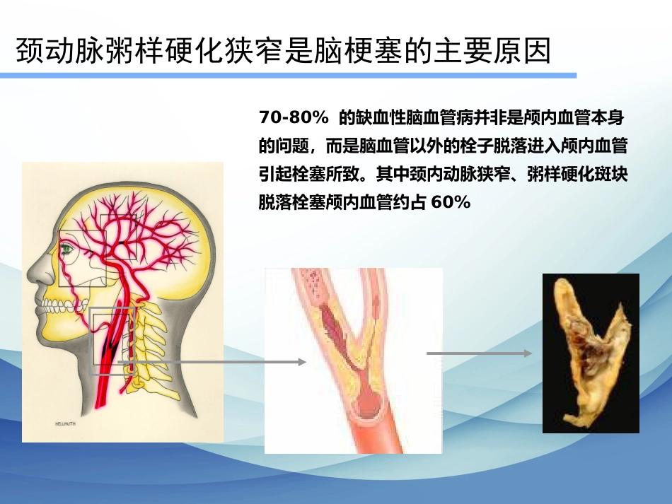 颈动脉狭窄的治疗科普讲座_第4页