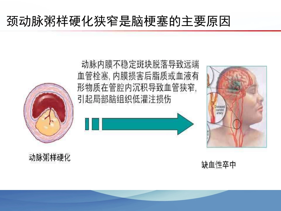 颈动脉狭窄的治疗科普讲座_第5页