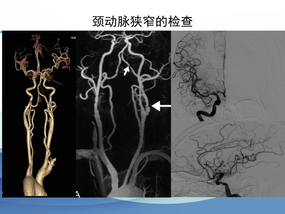 颈动脉狭窄的治疗科普讲座_第8页
