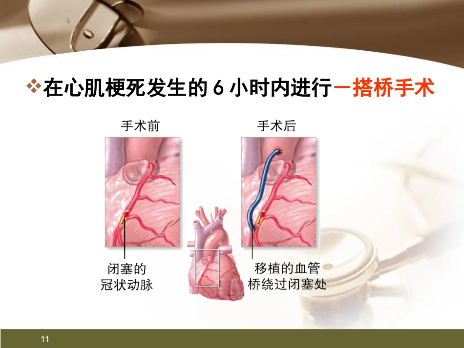 心肌梗死健康宣教PPT课件_第11页