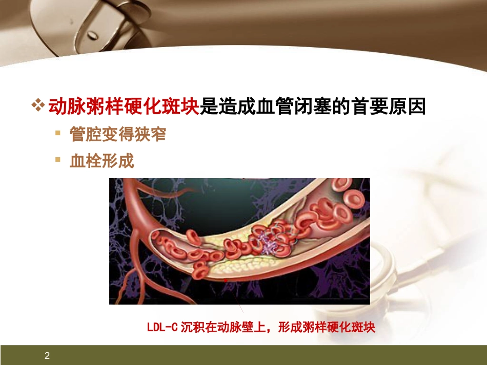 心肌梗死健康宣教PPT课件_第2页