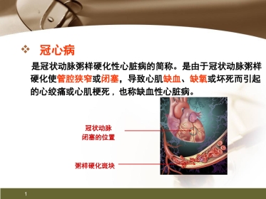 心肌梗死健康宣教PPT课件