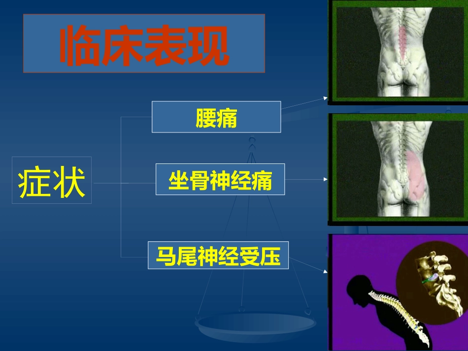 腰腿痛的认识与防治(健康讲座)_第14页
