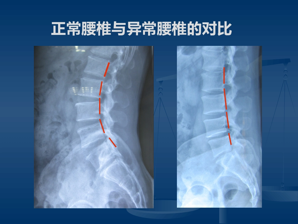 腰腿痛的认识与防治(健康讲座)_第4页