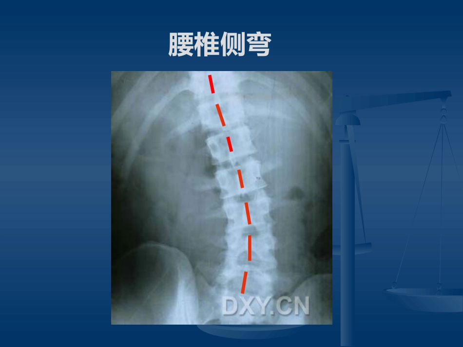 腰腿痛的认识与防治(健康讲座)_第5页