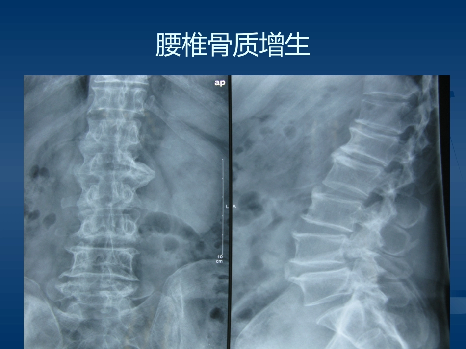 腰腿痛的认识与防治(健康讲座)_第6页