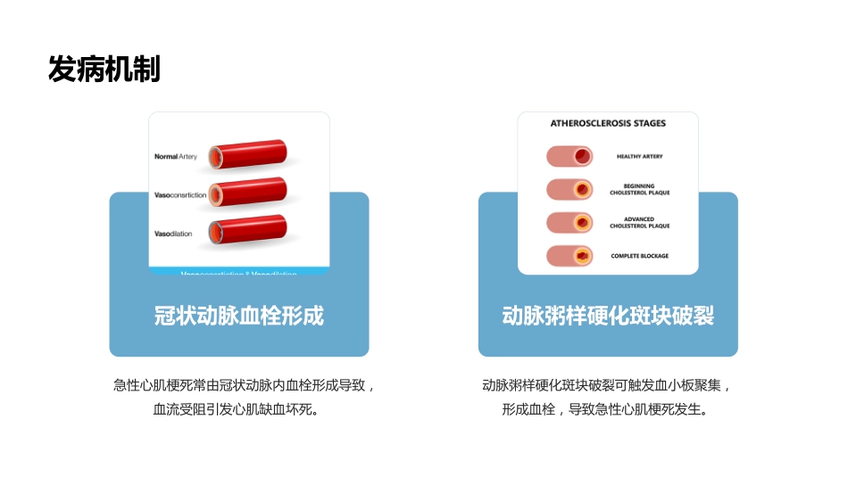 急性心肌梗死的健康宣教_第5页