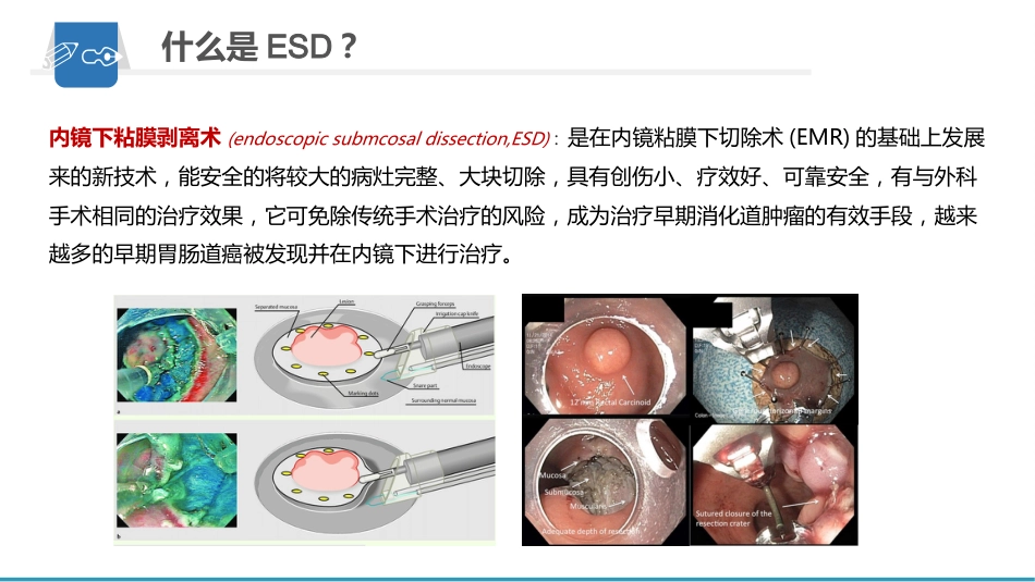 内镜下粘膜剥离术(ESD)护理要点及健康教育_第4页
