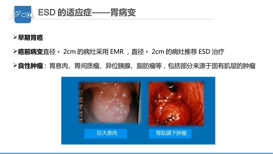 内镜下粘膜剥离术(ESD)护理要点及健康教育_第8页