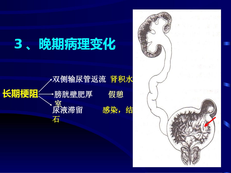 良性前列腺增生病_第10页