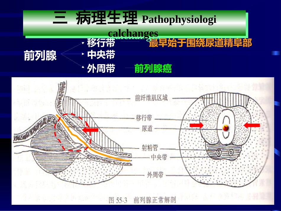 良性前列腺增生病_第6页