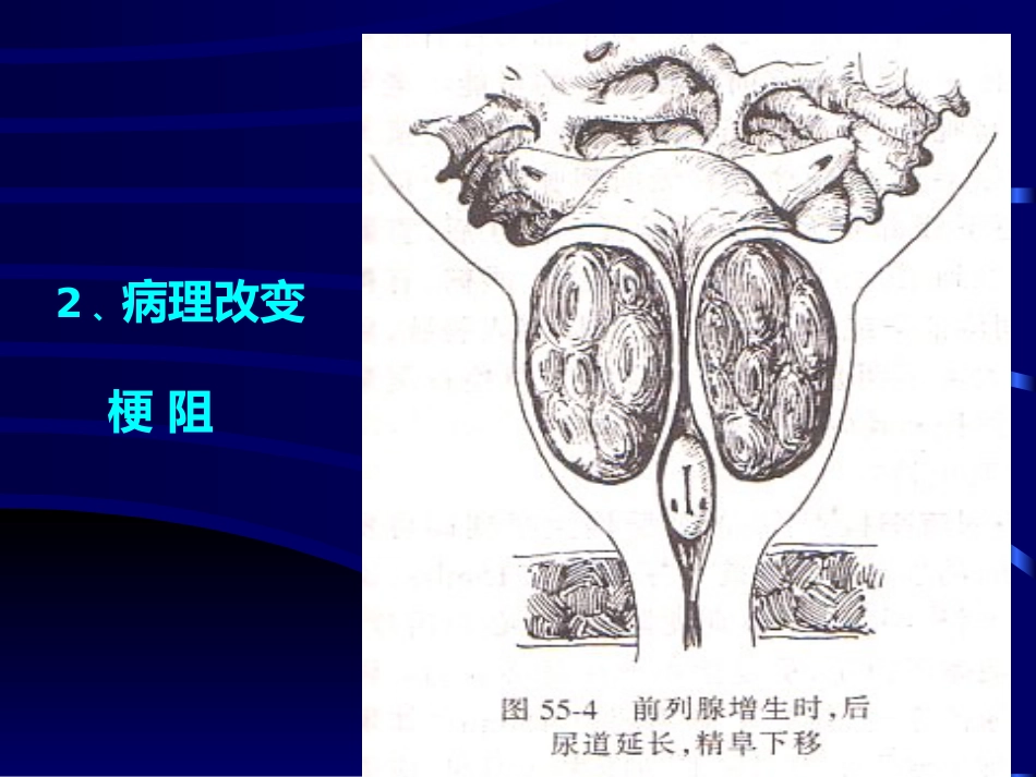 良性前列腺增生病_第7页