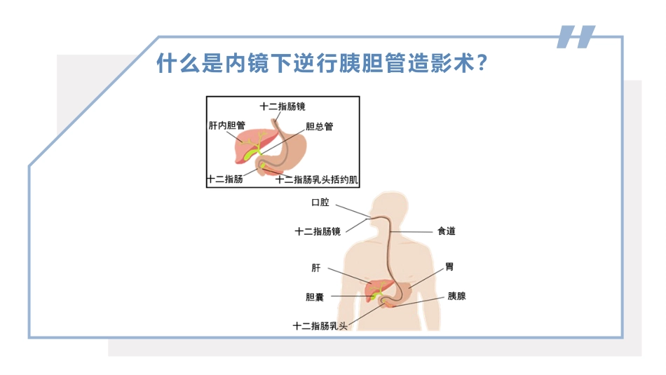 内镜下逆行胰胆管造影术(ERCP)健康宣教PPT课件_第5页