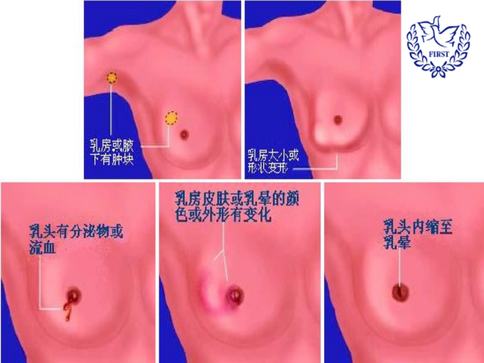 乳腺健康科普讲座_第13页