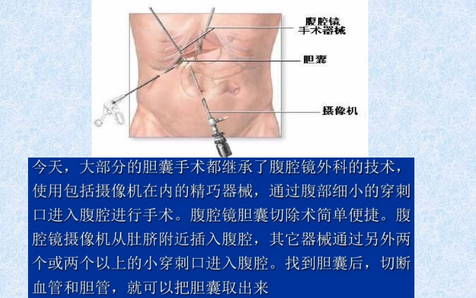 胆结石健康教育 ppt课件_第15页