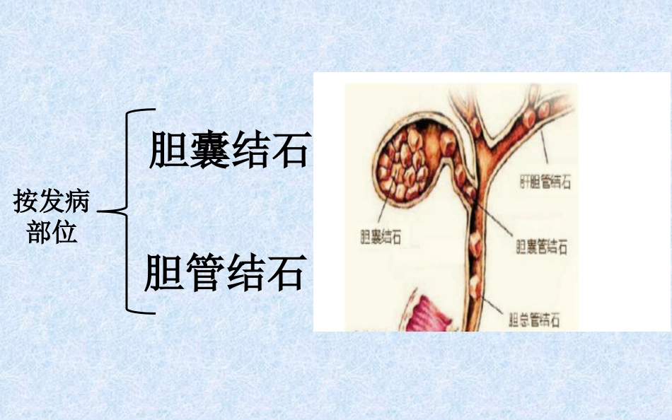 胆结石健康教育 ppt课件_第3页