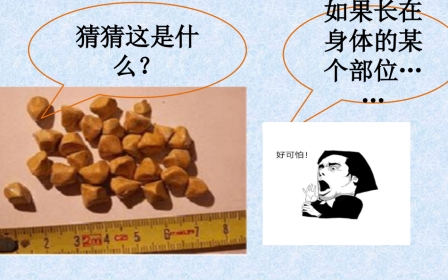 胆结石健康教育 ppt课件