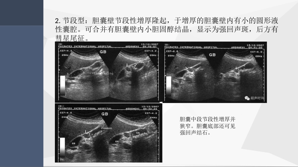 胆囊腺肌症超声PPT小讲座_第10页
