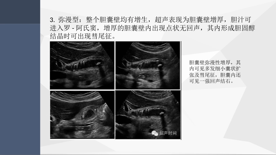 胆囊腺肌症超声PPT小讲座_第11页