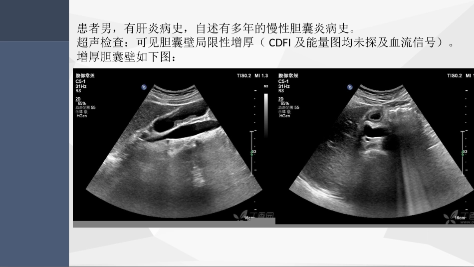 胆囊腺肌症超声PPT小讲座_第2页