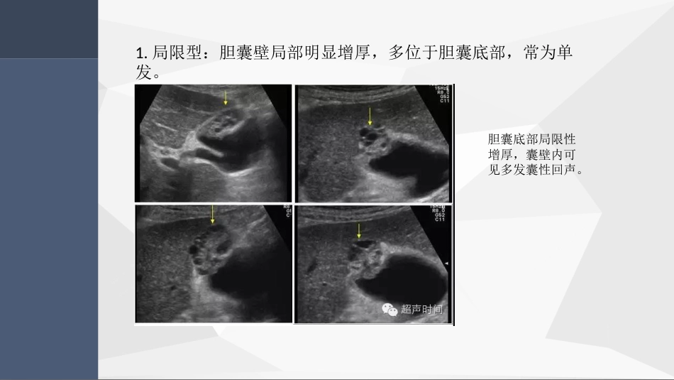 胆囊腺肌症超声PPT小讲座_第9页