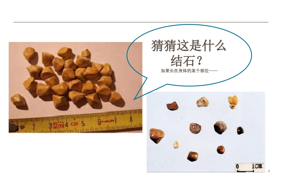 胆结石和泌尿系结石健康教育_第2页