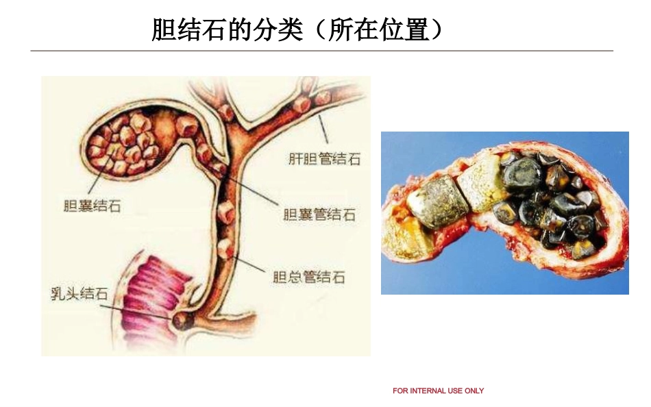 胆结石和泌尿系结石健康教育_第5页