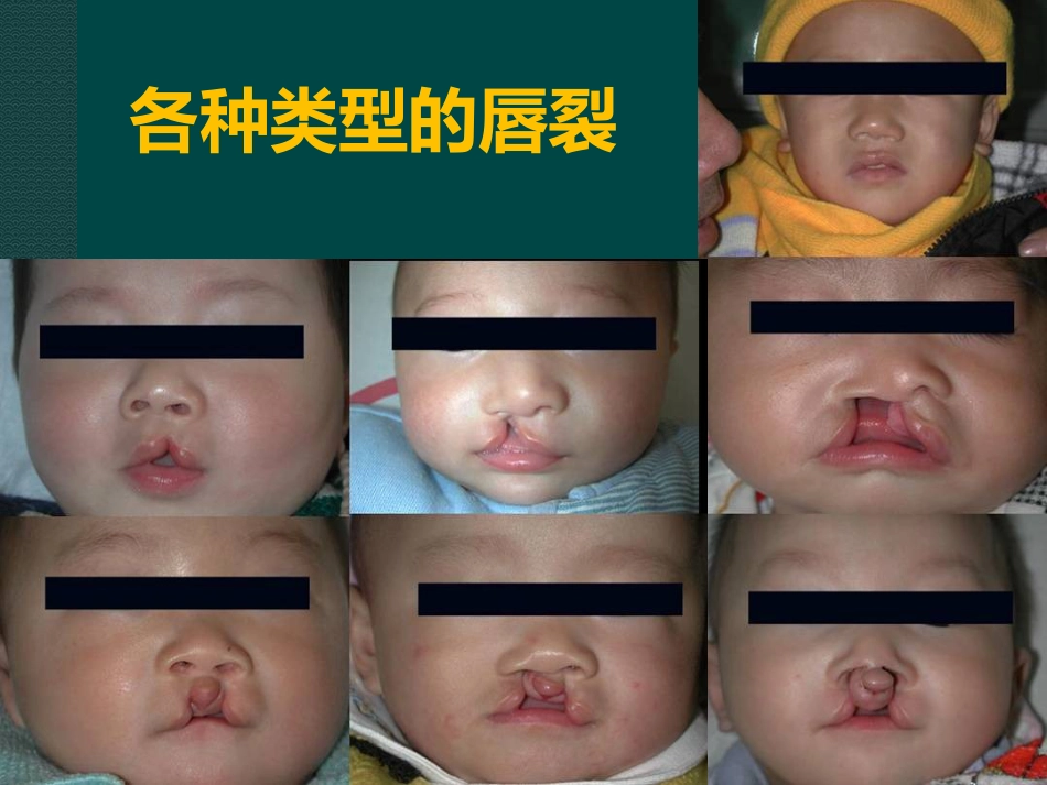 唇裂讲座_第14页