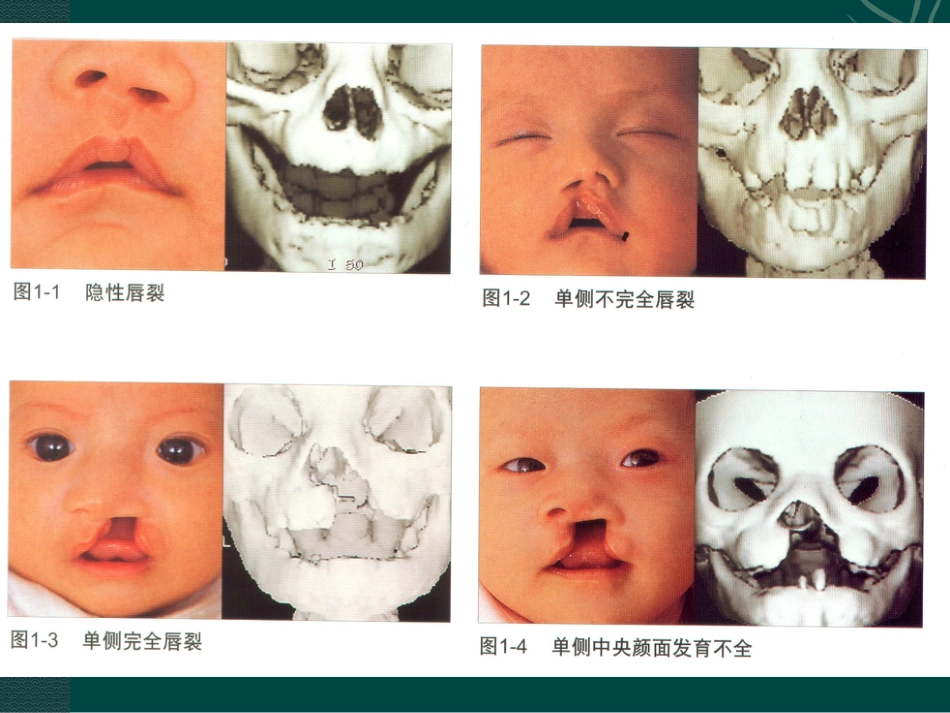 唇裂讲座_第15页