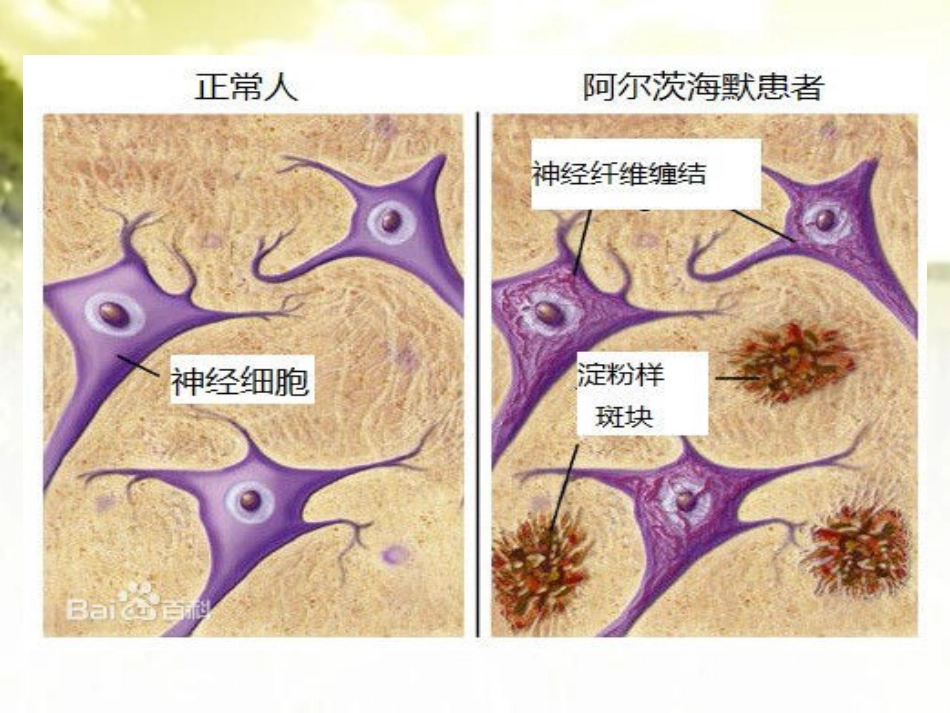 阿尔茨海默病健康讲座ppt_第10页