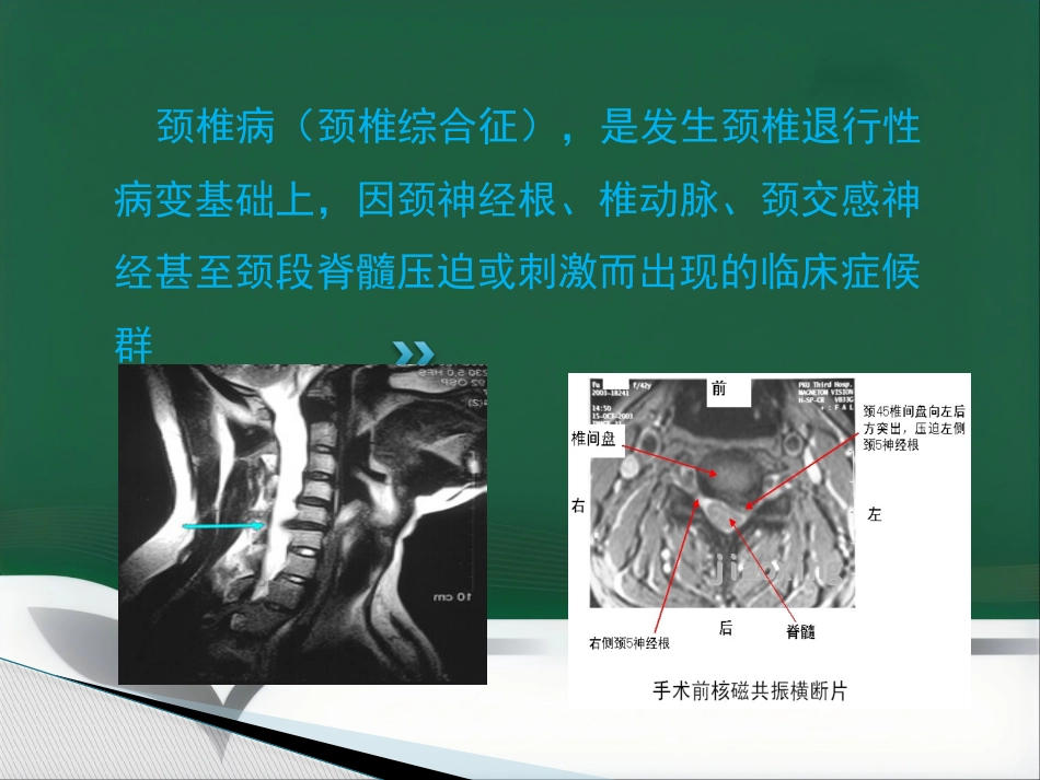 颈椎腰椎病科普讲座_第3页