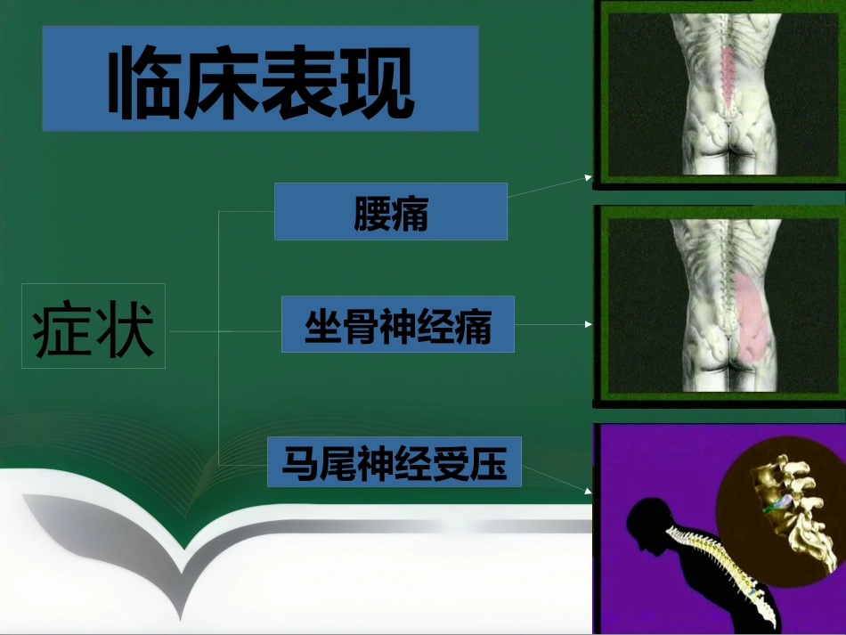 腰腿痛健康讲座_第13页
