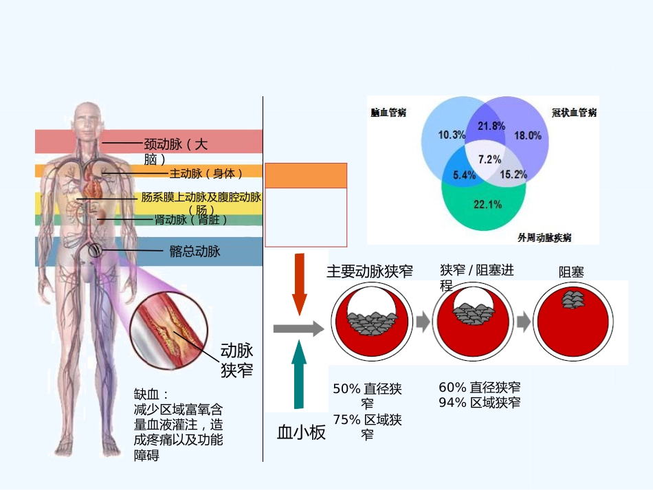 下肢动脉硬化闭塞症健康讲座_第6页