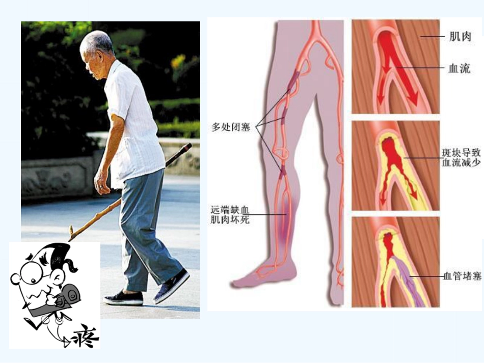 下肢动脉硬化闭塞症健康讲座_第7页