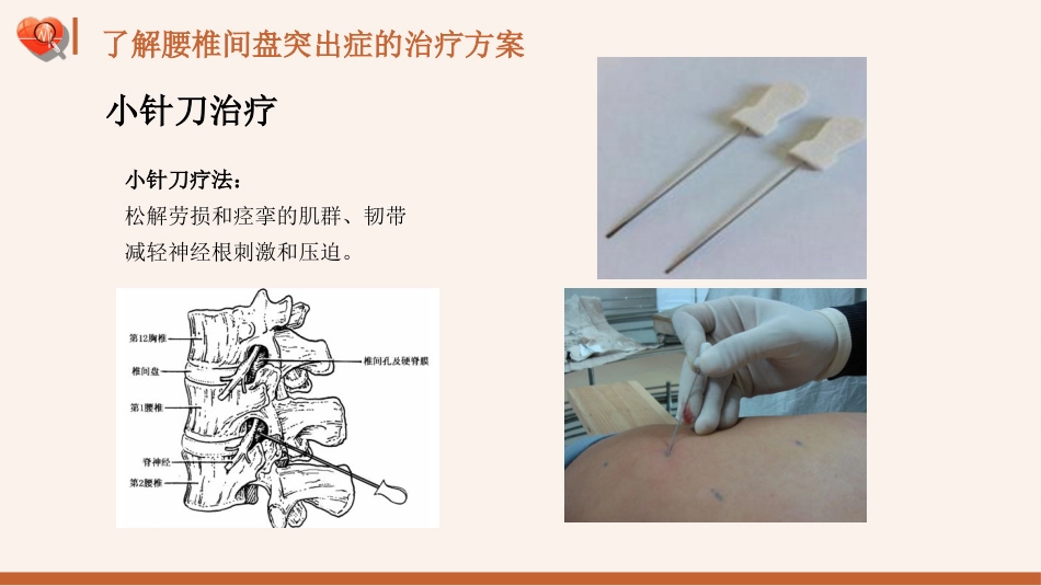 【医护指南】健康宣讲：腰椎间盘突出症健康教育1_第11页