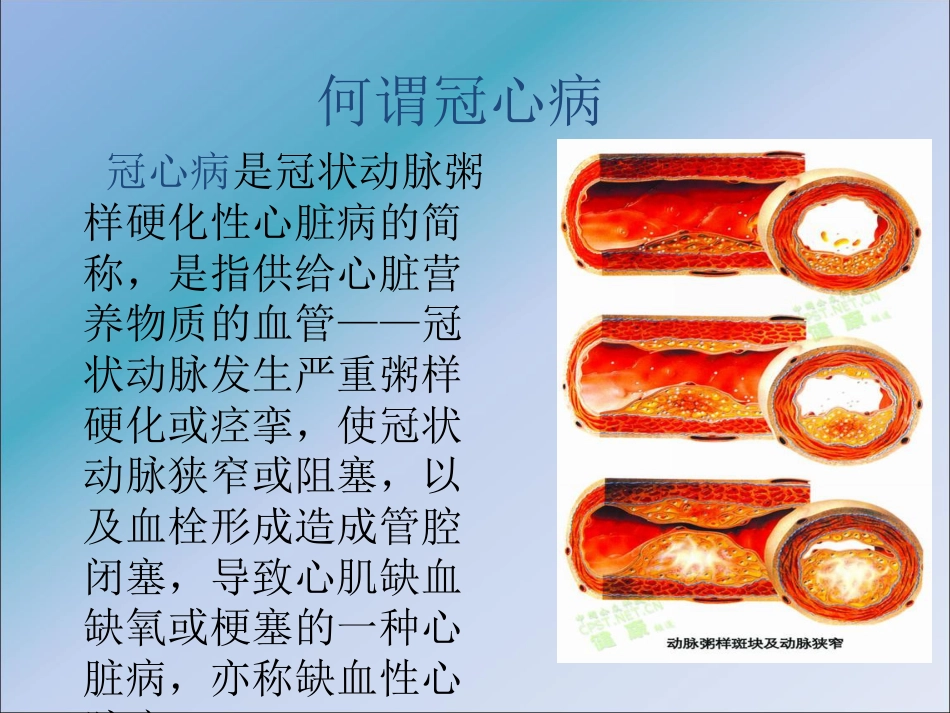 冠心病的中医预防_健康教育讲座ppt课件_第6页