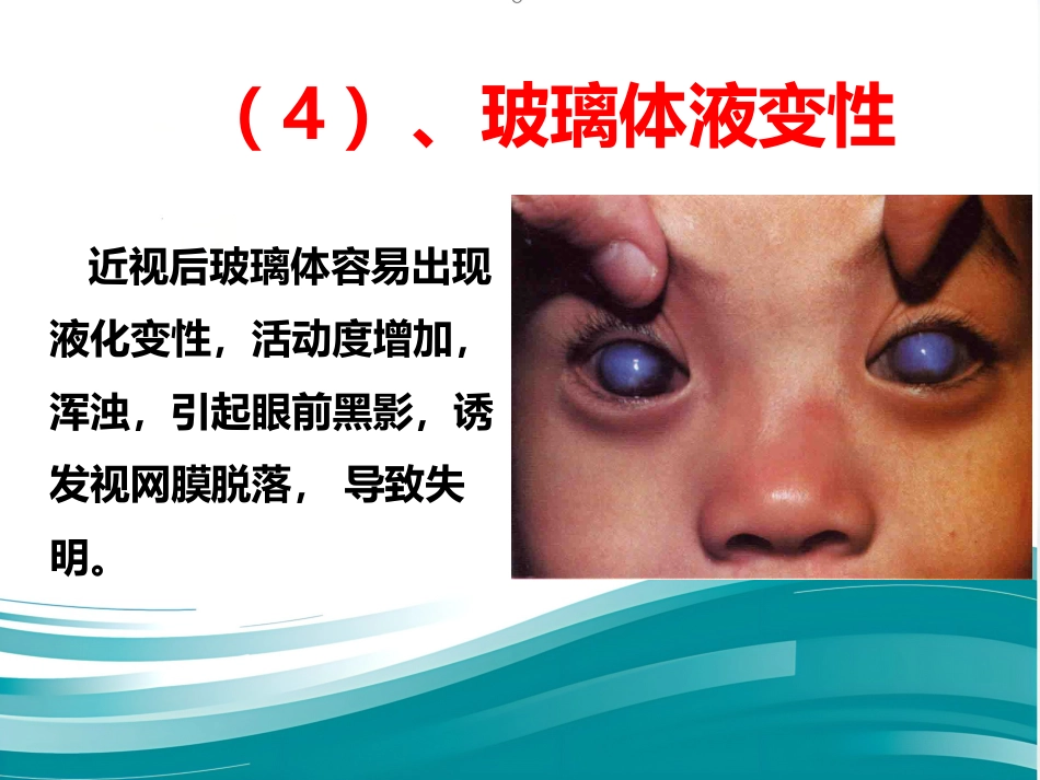 爱眼护眼科普讲座PPT幻灯片_第8页