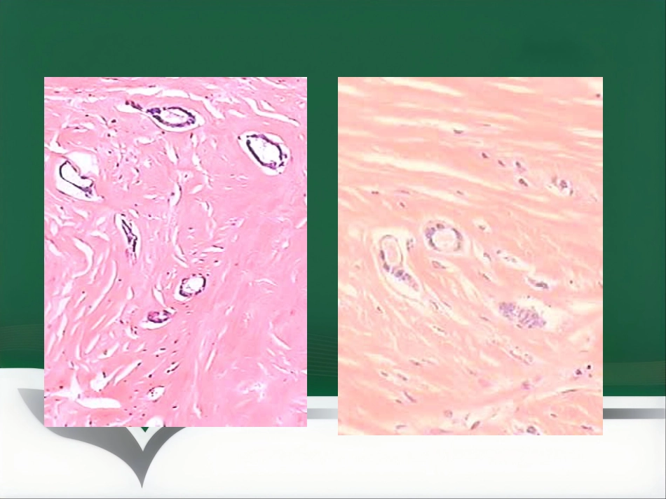 乳腺病理要点讲座_第8页