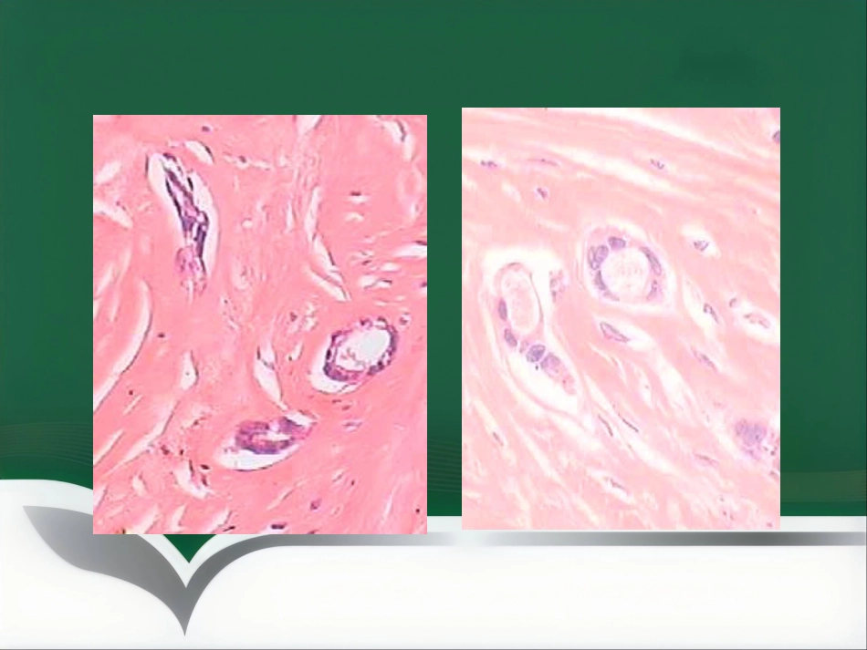 乳腺病理要点讲座_第9页