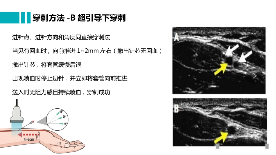 桡动脉穿刺置管操作与压力监测_第10页